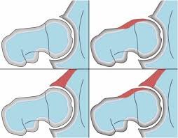 FAI Treatment in Delhi